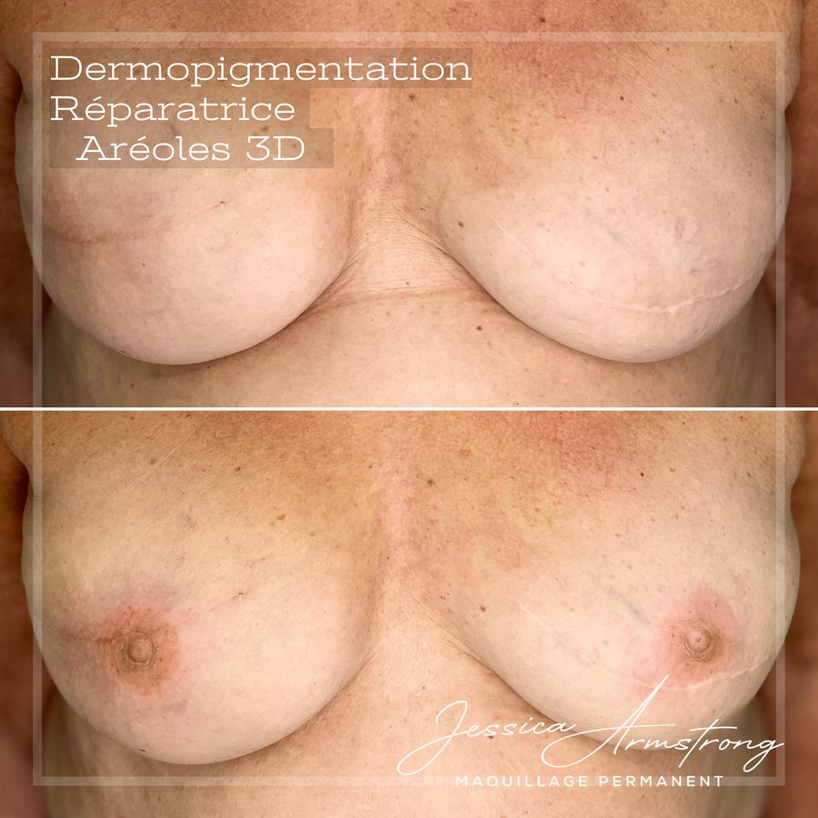 Avant et après reconstruction d'aréoles 3D féminines après mastectomie