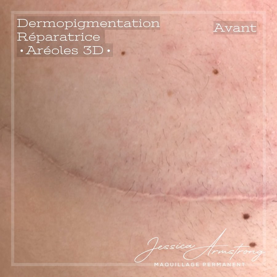 Avant reconstruction d'aréole 3D, masculinisation post-mastectomie