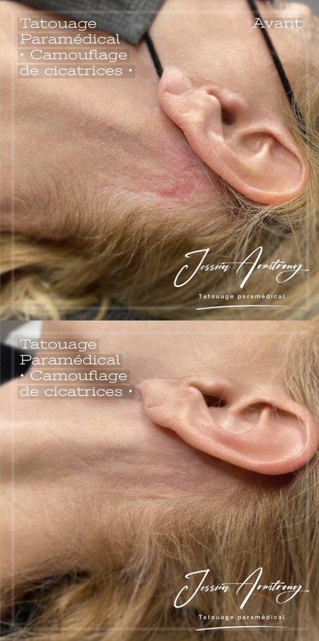 Avant-après camouflage de cicatrice en tatouage paramédical