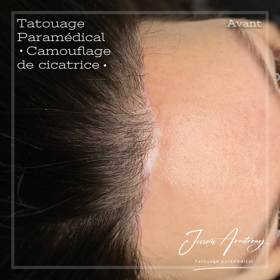 Avant camouflage d'une cicatrice à la racine des cheveux
