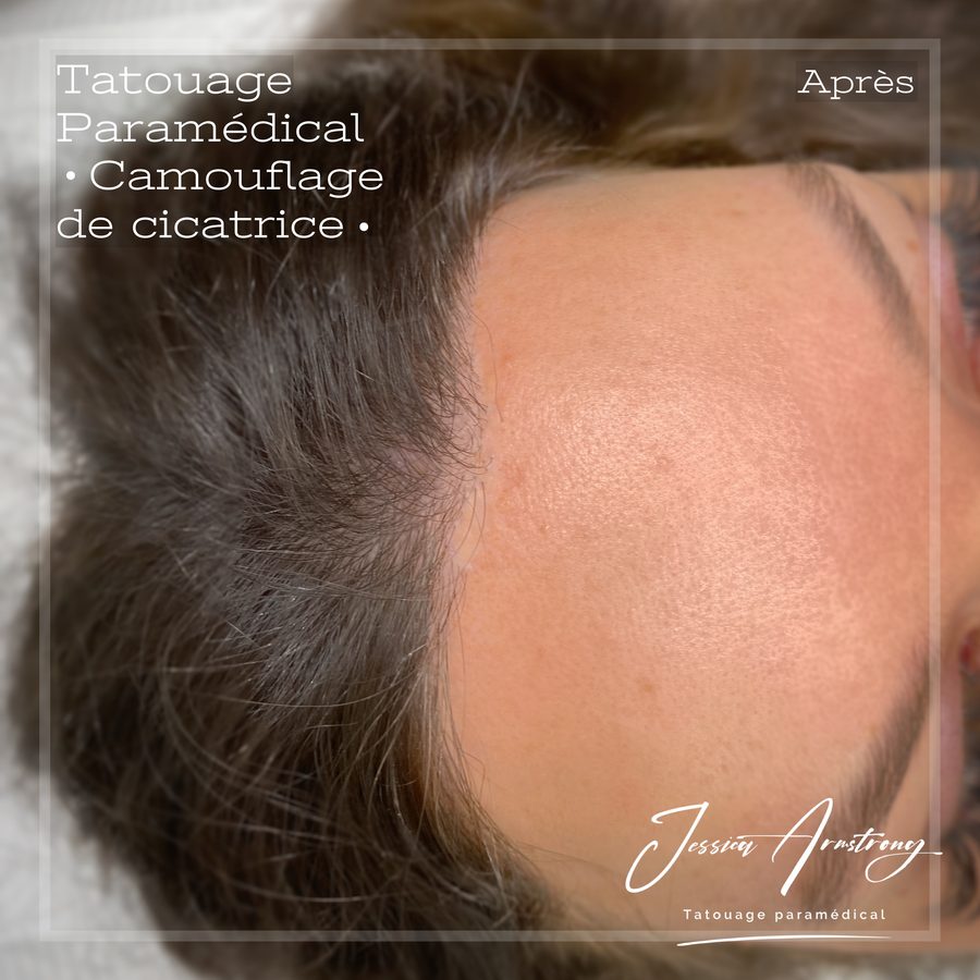 Après camouflage d'une cicatrice à la racine des cheveux