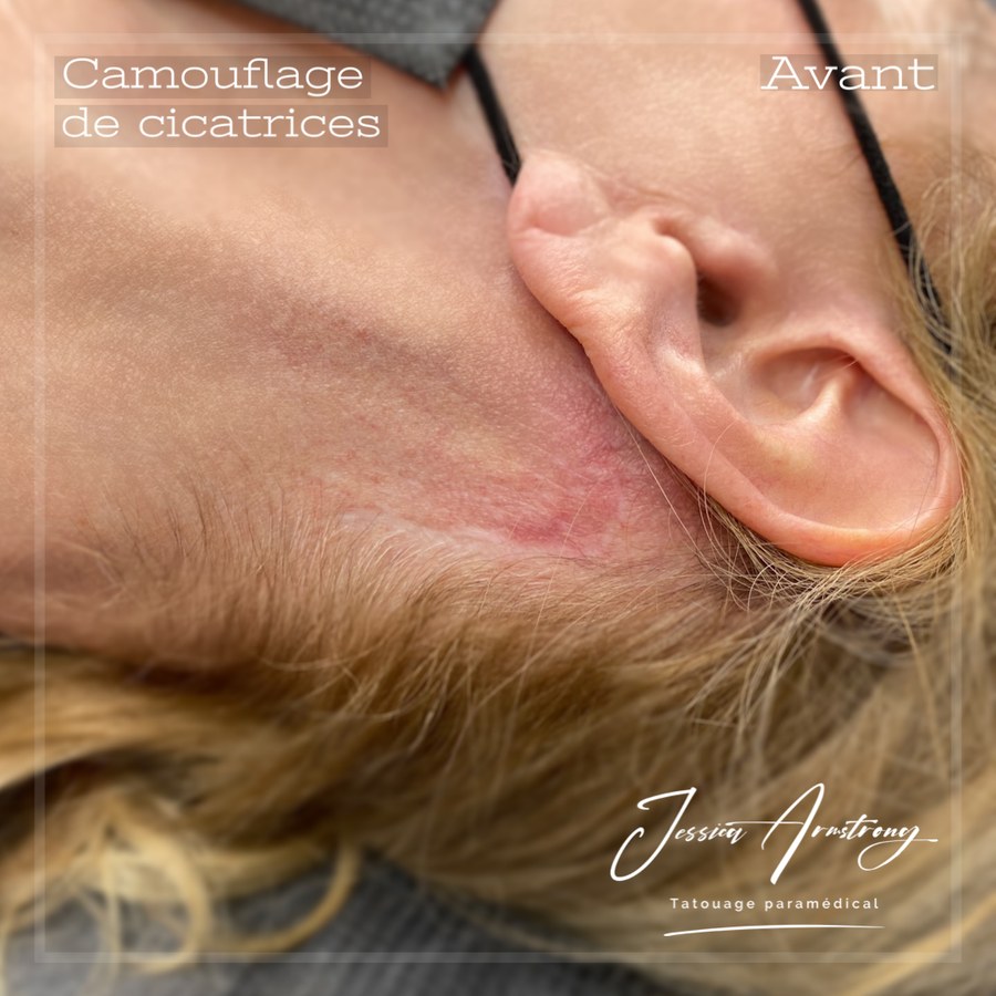 Avant camouflage de cicatrice près de l'oreille