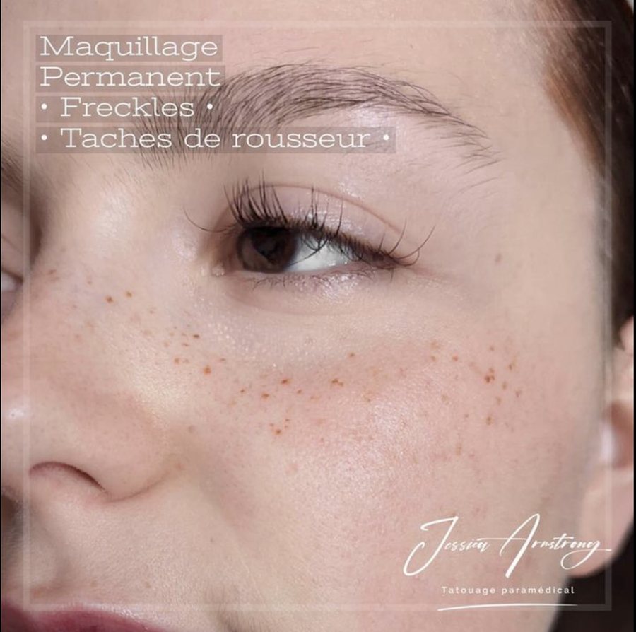 Résultat de tatouage de taches de rousseur