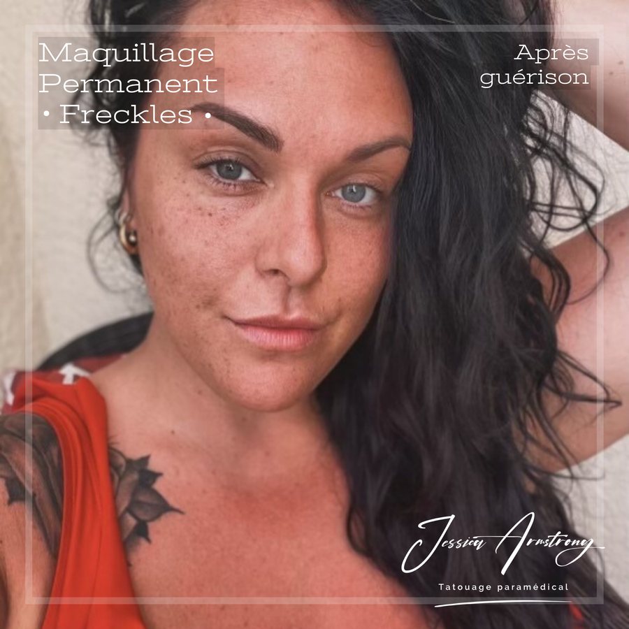 Résultat de tatouage de taches de rousseur